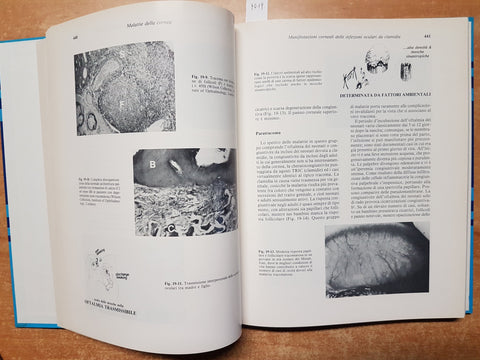 MALATTIE DELLA CORNEA - LEIBOWITZ 1987 VERDUCI