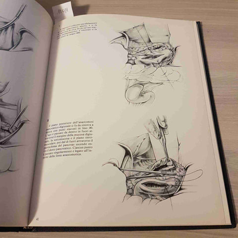 TECNICHE CHIRURGICHE ILLUSTRATE VOL. 2 NO. 4 - PANCREATITE CRONICA -VERDUCI-1979