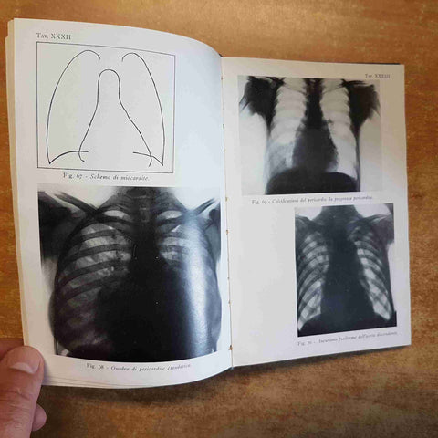 DIAGNOSTICA MEDICA DIFFERENZIALE 2 voll. ADOLFO FERRATA 1939 con pagine staccate