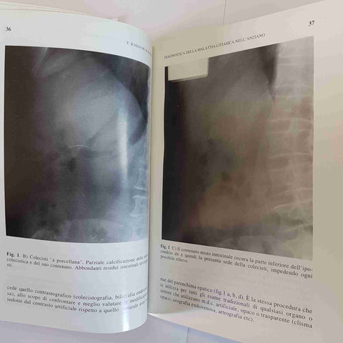LA LITIASI BILIARE NELL ANZIANO PILOTTO DEL FAVERO DI MARIO PICCIN MEDICO 1994