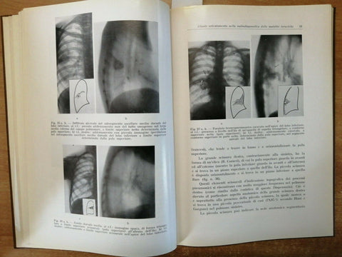 BEVILACQUA - ATTUALE ORIENTAMENTO NELLA RADIODIAGNOSTICA TORACICA (2669