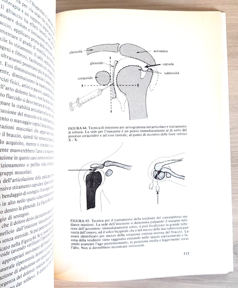 La spalla nell'emiplegia - Rene Cailliet - Marrapese 1984 illustrato (5365