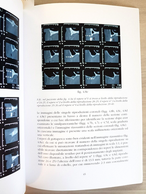 La stabilizzazione delle protesi mobili con impianti di piccolo calibro +DVD7515