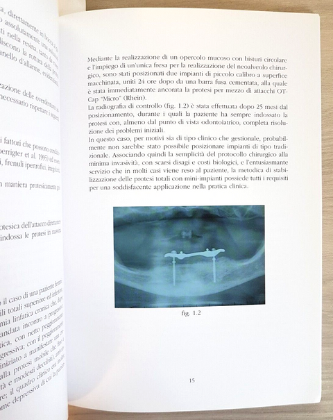La stabilizzazione delle protesi mobili con impianti di piccolo calibro +DVD7515