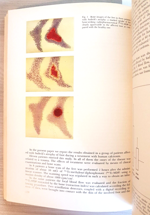 HUMAN CALCITONIN calcitonina umana - A. CANIGGIA - STRESA 1982 - MEDICINA (